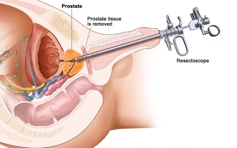 جراحی لیزری پروستات اراک