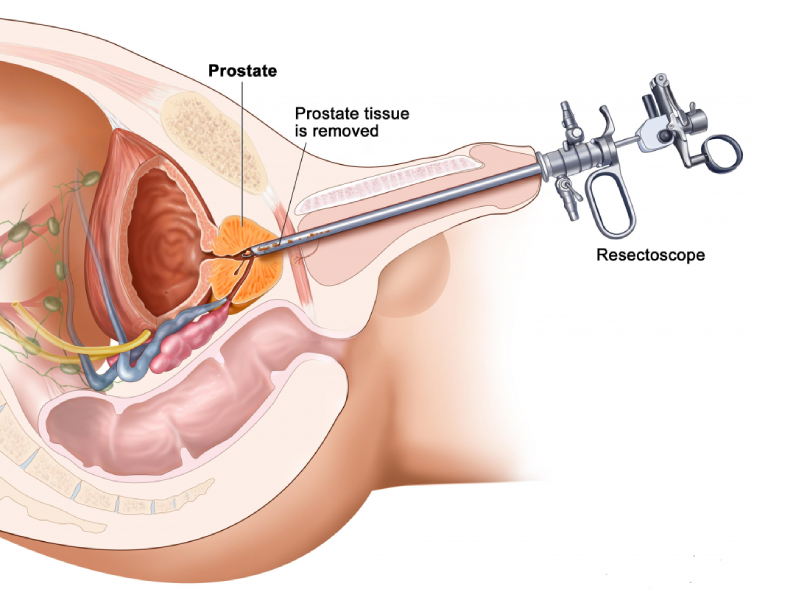جراحی لیزری پروستات اراک