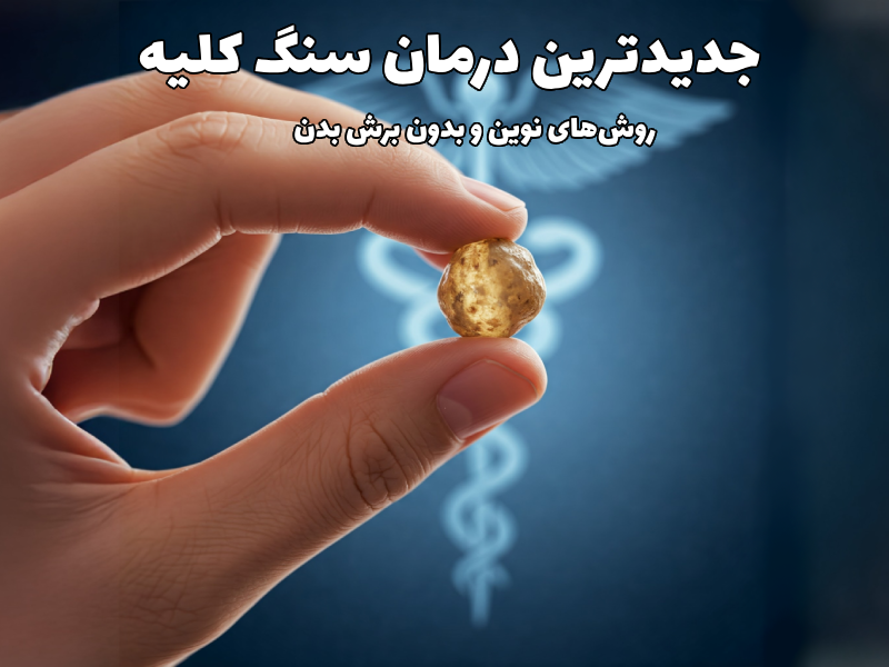 جدیدترین درمان سنگ کلیه
