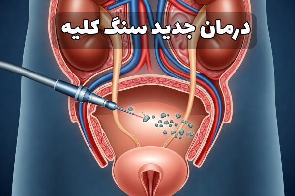 درمان جدید سنگ کلیه