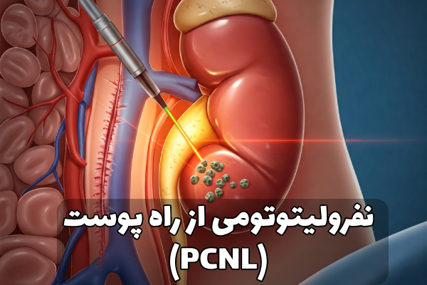 درمان جدید سنگ کلیه