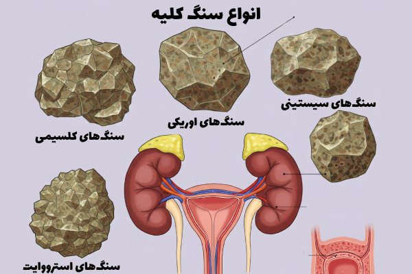 درمان جدید سنگ کلیه