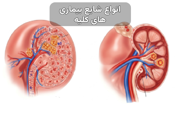 بیماری های کلیه