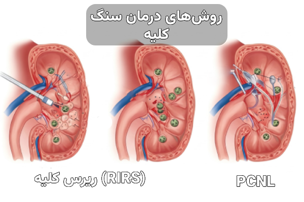 بیماری های کلیه