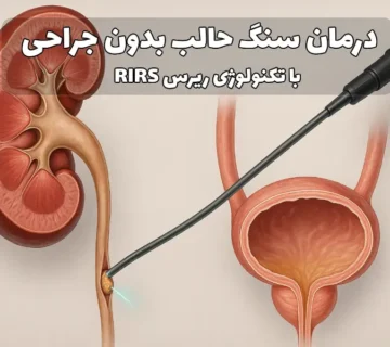درمان سنگ حالب بدون جراحی (RIRS)