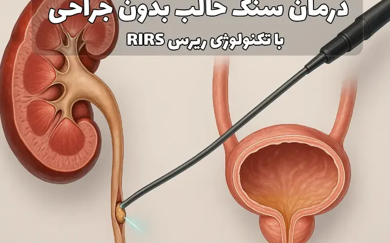 درمان سنگ حالب بدون جراحی (RIRS)