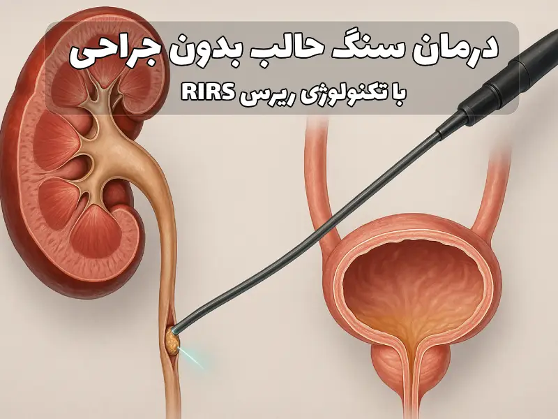 درمان سنگ حالب بدون جراحی (RIRS)
