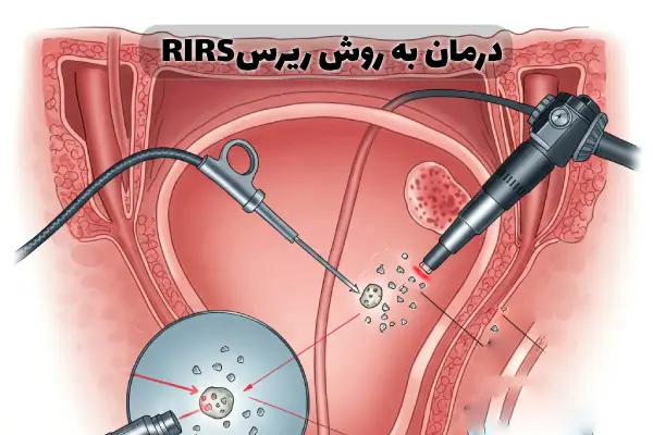 درمان سنگ حالب بدون جراحی