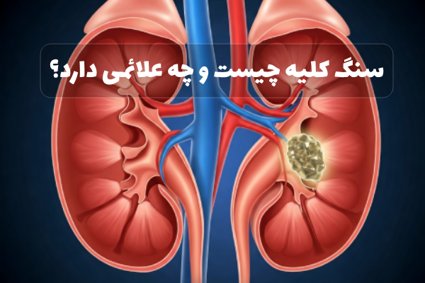 درمان غیر جراحی سنگ کلیه اراک