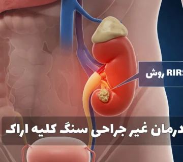 درمان غیر جراحی سنگ کلیه اراک