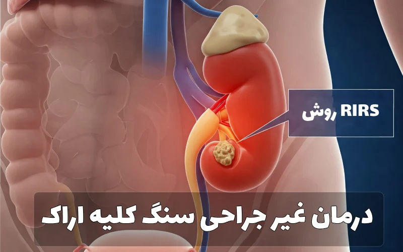 درمان غیر جراحی سنگ کلیه اراک
