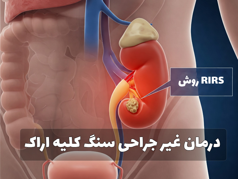 درمان غیر جراحی سنگ کلیه اراک
