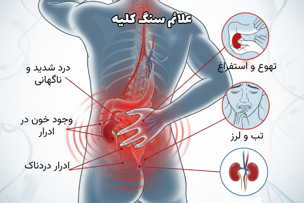 موفق ترین درمان سنگ کلیه