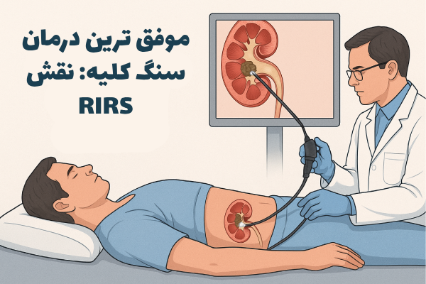 موفق ترین درمان سنگ کلیه