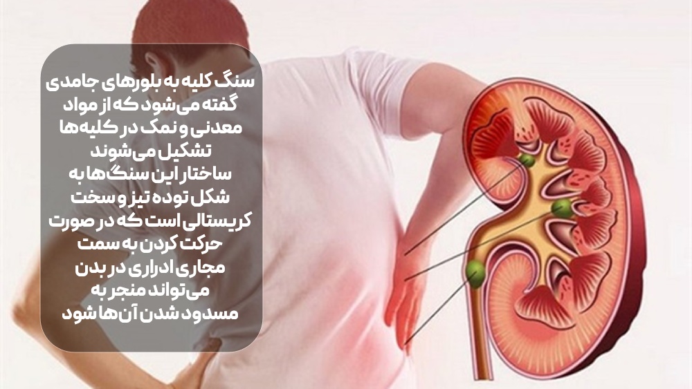 سنگ کلیه چیست