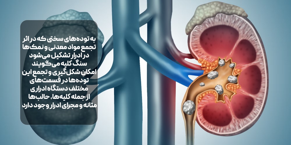 سنگ کلیه چیست