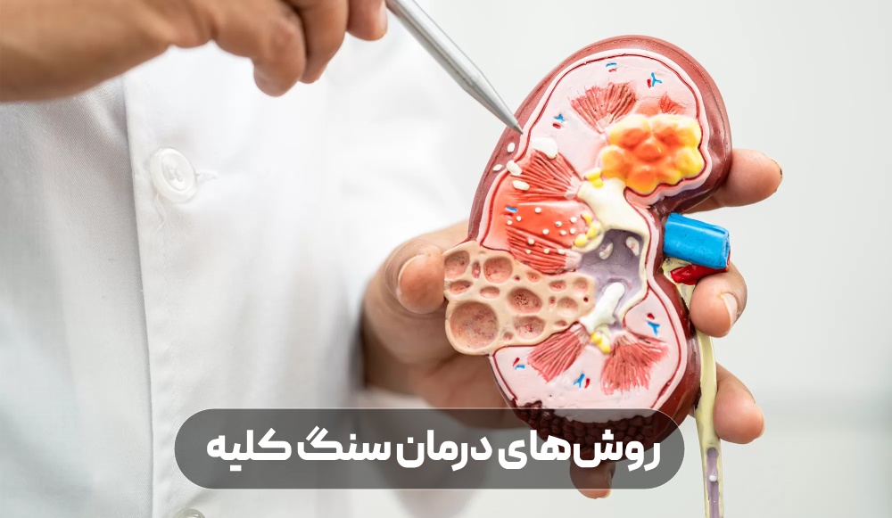 روش های درمان سنگ کلیه