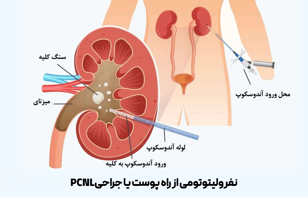 جراحی PCNL