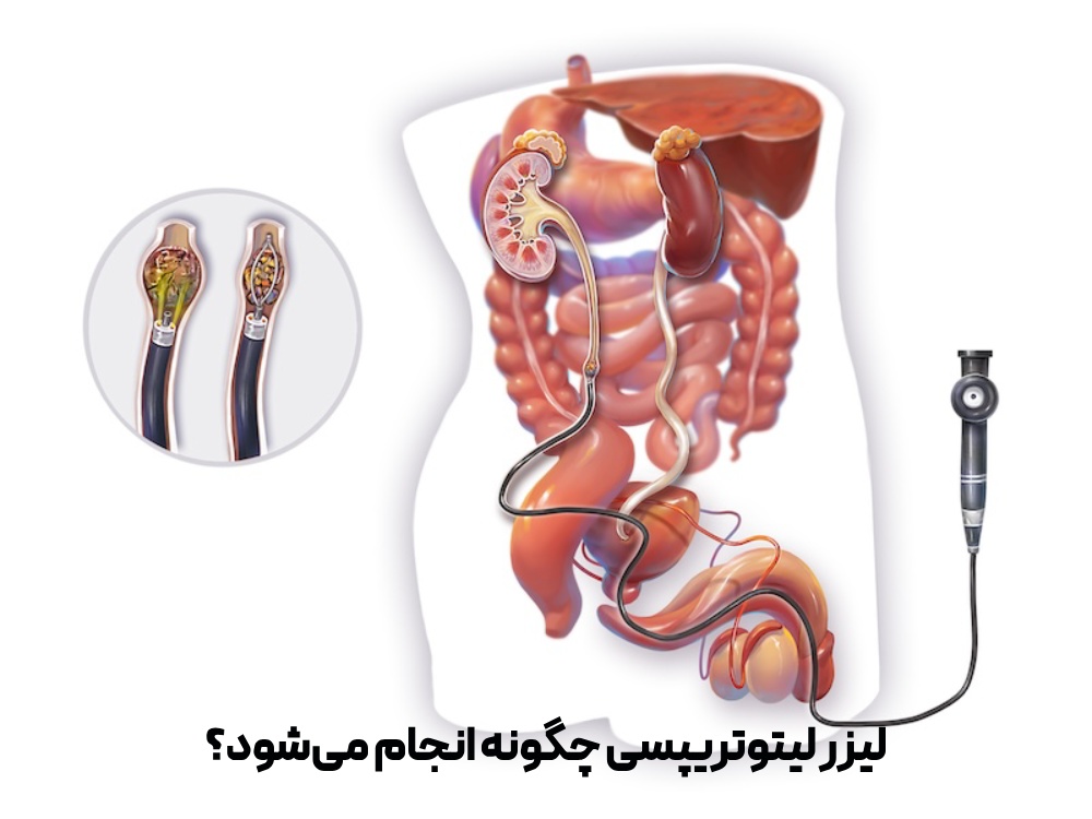 لیزر لیتوتریپسی کلیه