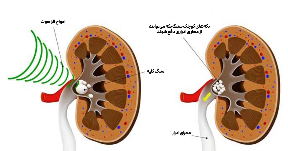 درمان سنگ کلیه به روش ESWL