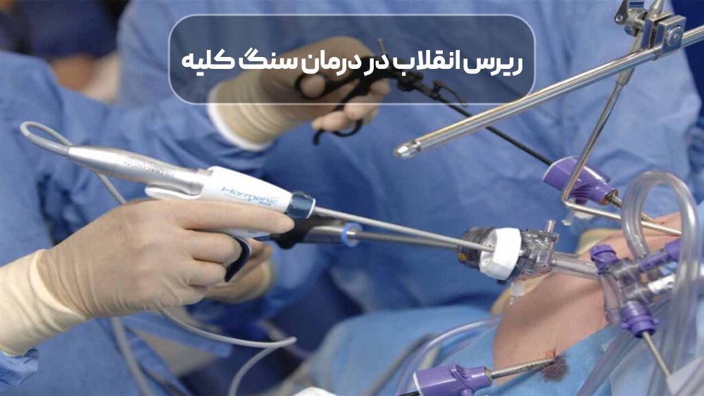 ریرس انقلاب در درمان سنگ کلیه