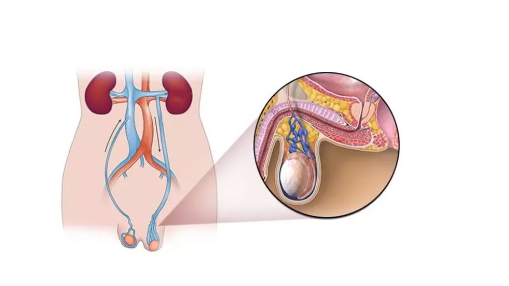 واریکوسل چیست