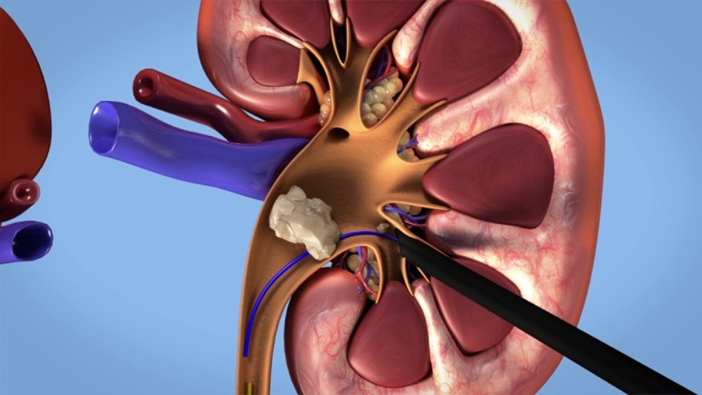 مزایای ساکشن در یورتروسکوپی