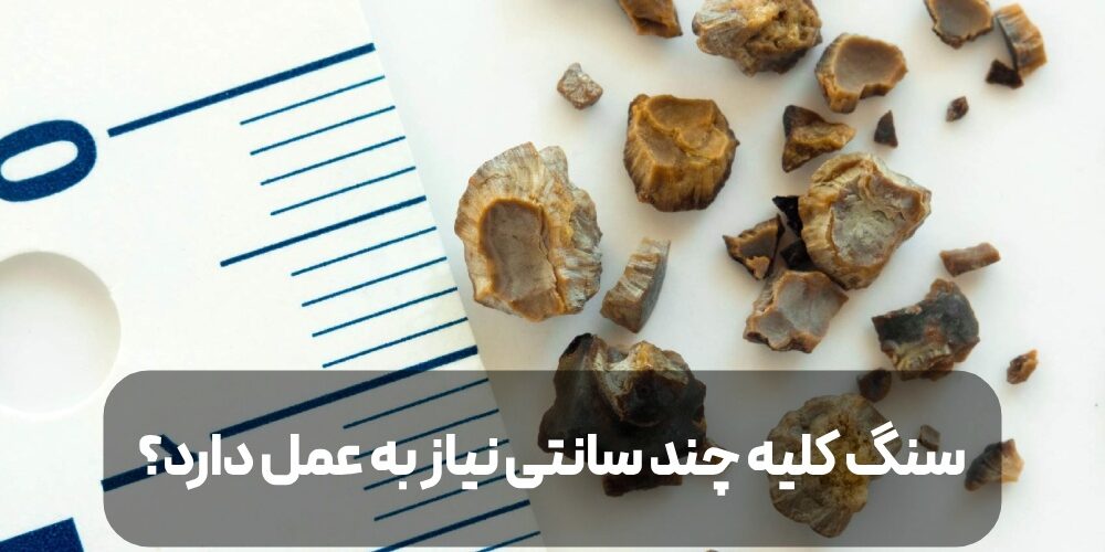 درمان سنگ کلیه