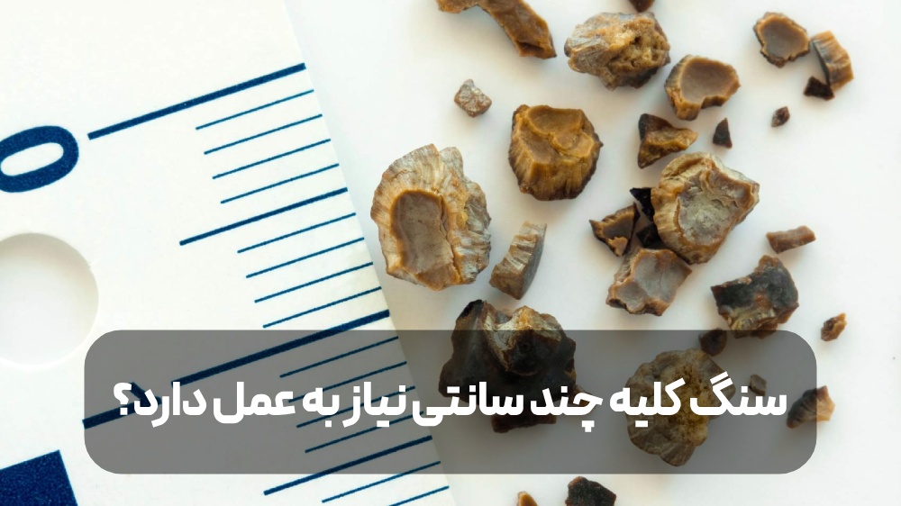 درمان سنگ کلیه