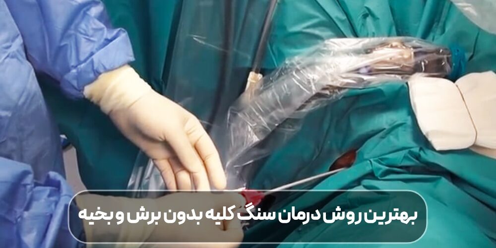 درمان سنگ کلیه بدون برش و بخیه