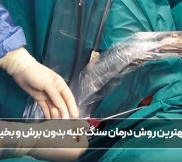 درمان سنگ کلیه بدون برش و بخیه