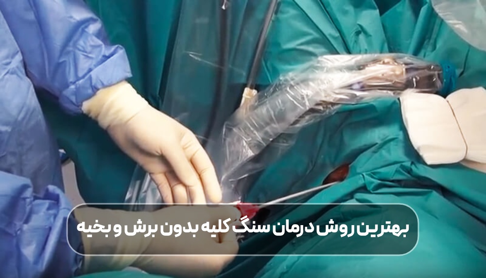 درمان سنگ کلیه بدون برش و بخیه