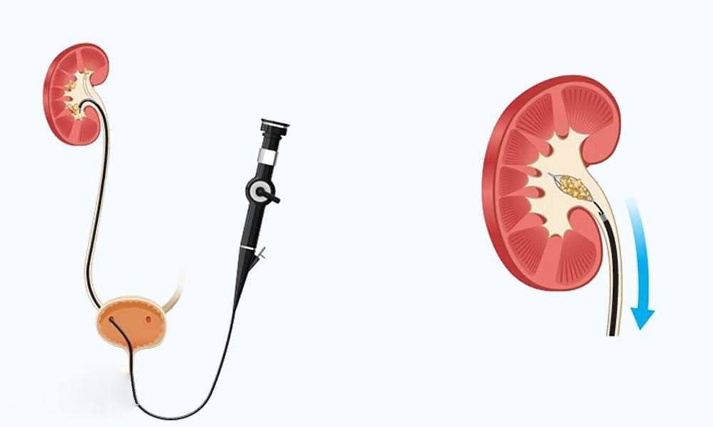 آشنایی با عوارض احتمالی RIRS 