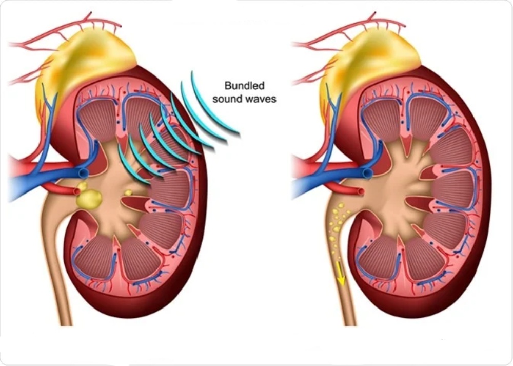 مزایای BWL و پرپالشن اولتراسوند