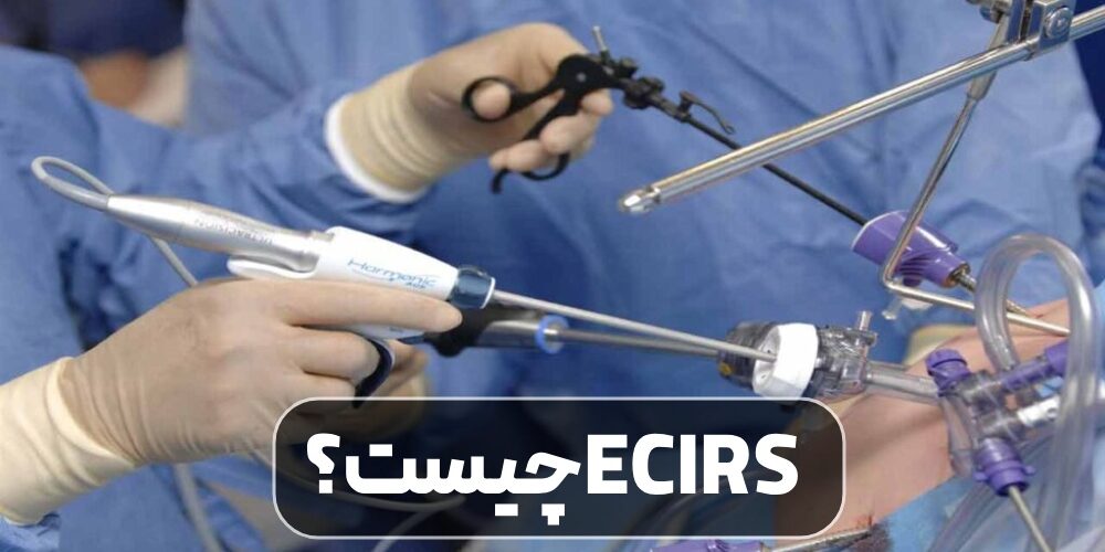 ECIRS چیست