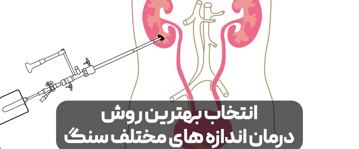 بهترین روش درمان اندازه های مختلف سنگ