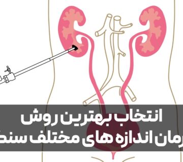 بهترین روش درمان اندازه های مختلف سنگ