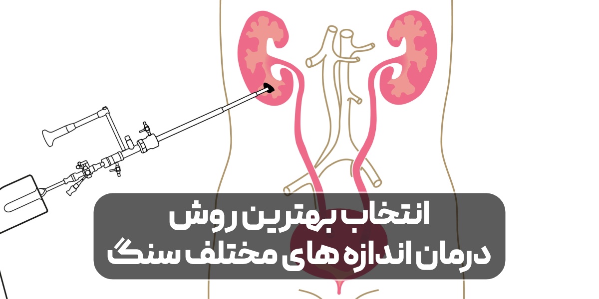 بهترین روش درمان اندازه های مختلف سنگ