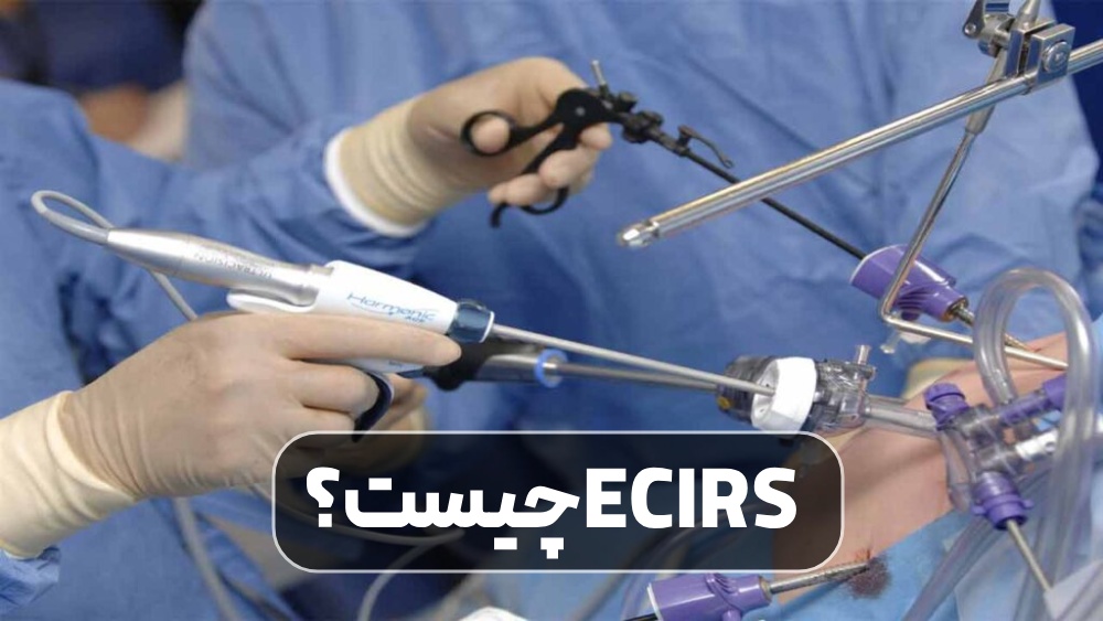 ECIRS چیست