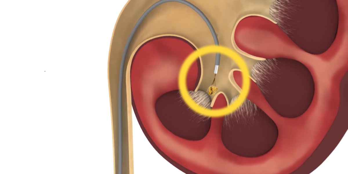 مزایای درمان سنگ کلیه با لیزر (RIRS)