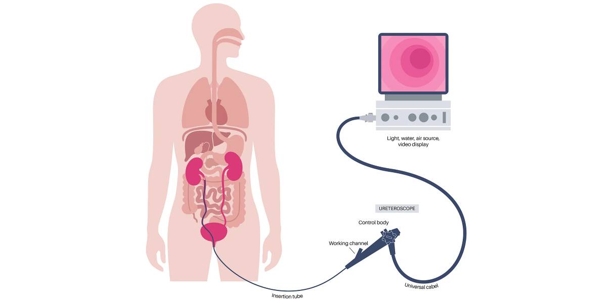 نحوه درمان سنگ مقاوم به سنگ شکن
