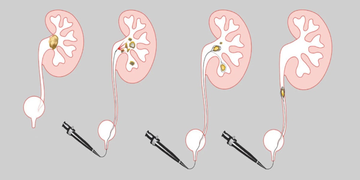 درمان سنگ کلیه با لیزر (RIRS) در اراک