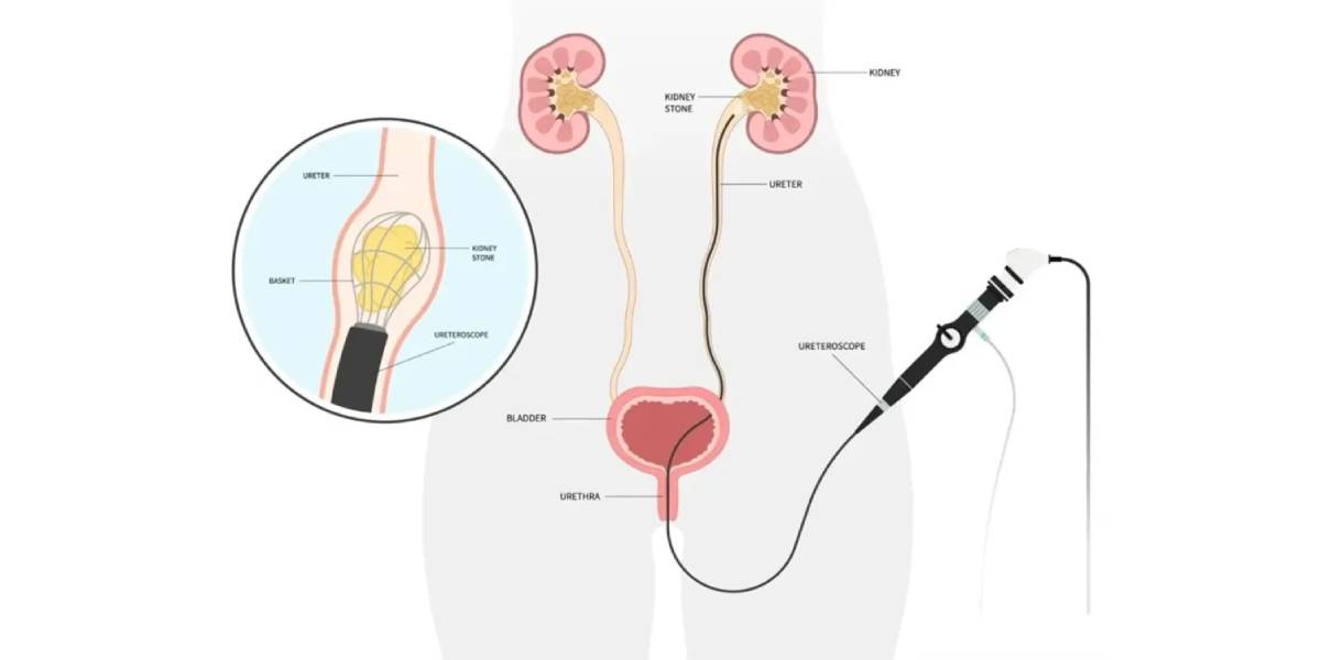 نحوه انجام روش ریرس