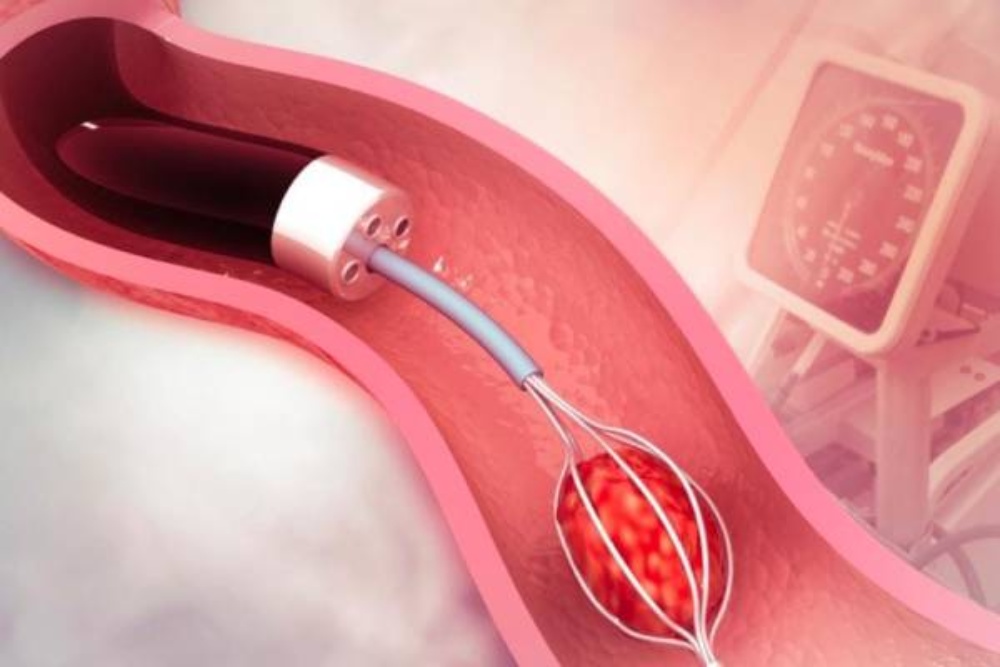 نحوه انجام ECIRS چیست