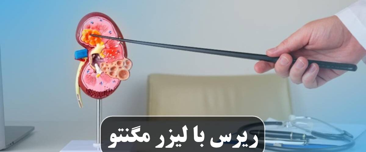 ریرس با لیزر مگنتو
