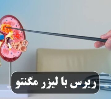 ریرس با لیزر مگنتو