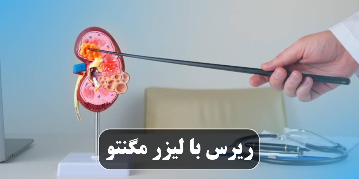 ریرس با لیزر مگنتو