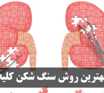 بهترین روش سنگ شکن کلیه