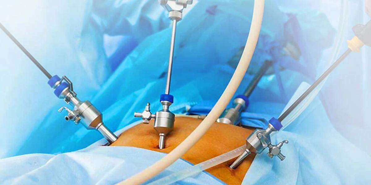 روش ریرس با لیزر مگنتو