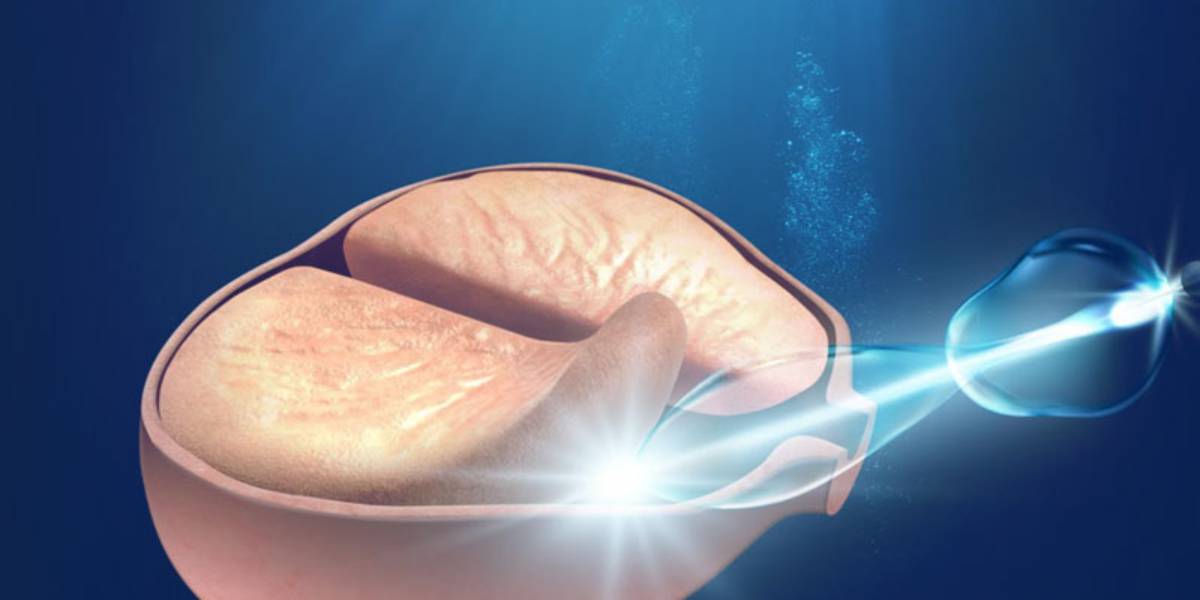 تکنولوژی هولپ مگنتو در درمان پروستات